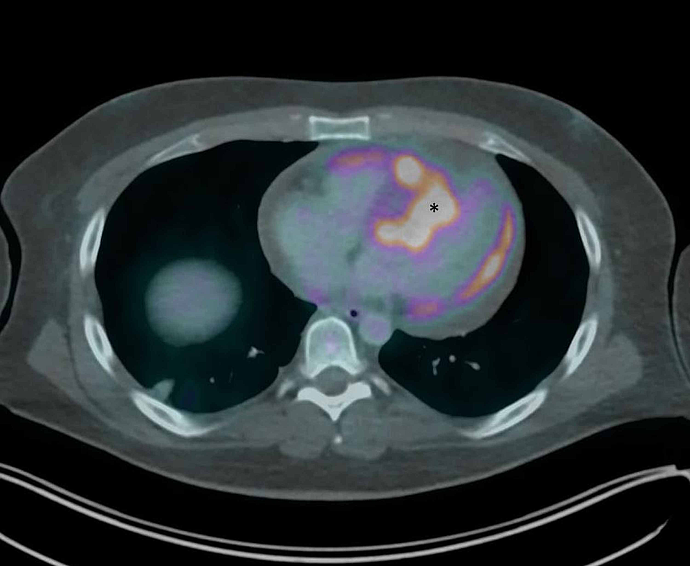 Cureus Metastatic Cardiac Tumor Presenting as an Anteroseptal ST