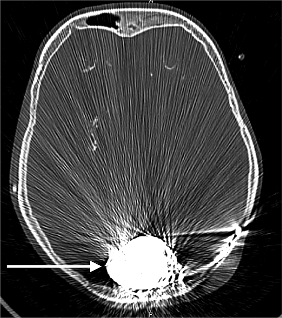 Cureus | A Combined Open and Endovascular Approach for the ...