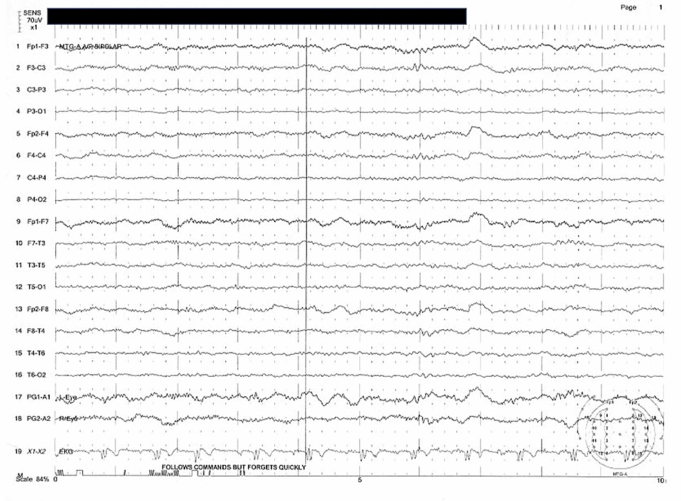 Cureus | Wernicke Encephalopathy in an Elderly Patient Due to Chronic ...