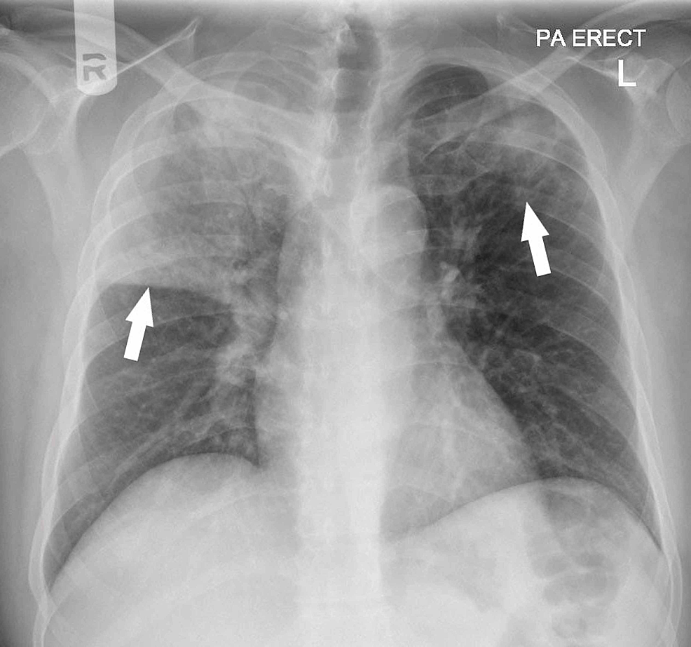 Cureus | Venous Thromboembolism: An Unusual Presentation of Pulmonary ...