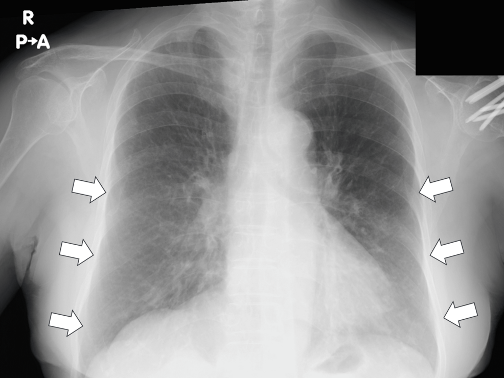 Central Adrenal Insufficiency Unmasked After Pneumonia-Associated Asthma Exacerbation Leading to the Diagnosis of Rathke’s Cleft Cyst in an Elderly Woman: A Case Report