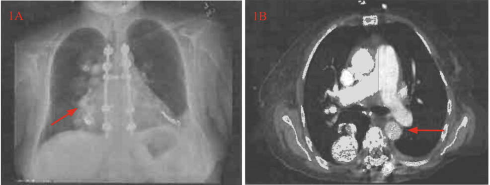 Severe Anemia and GI Bleeding in Hereditary Hemorrhagic Telangiectasia