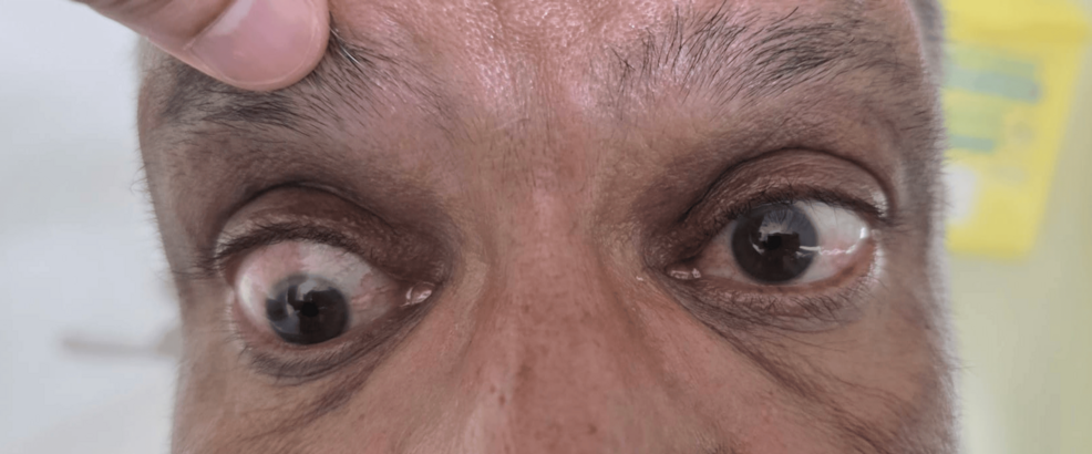 Resolving Thyroid Eye Disease Diplopia with Myopic Cataract Surgery