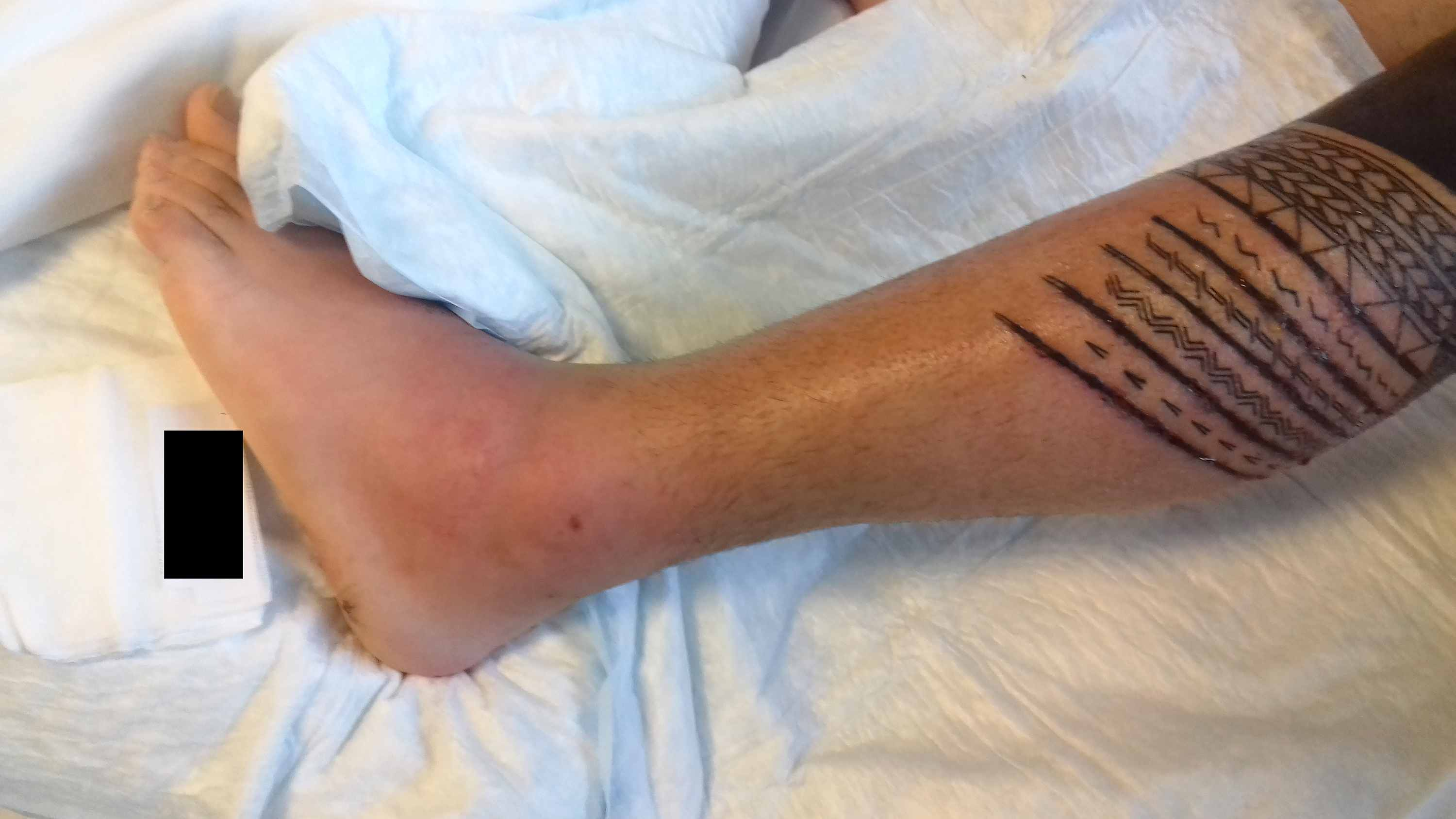 Cureus | Legal Tattoo Complicated by Sepsis and Necrotizing Fasciitis  Requiring Acute Surgery | Article