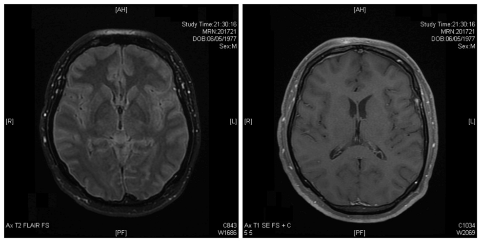 headline: Severe Acute Respiratory Syndrome <b>Coronavirus</