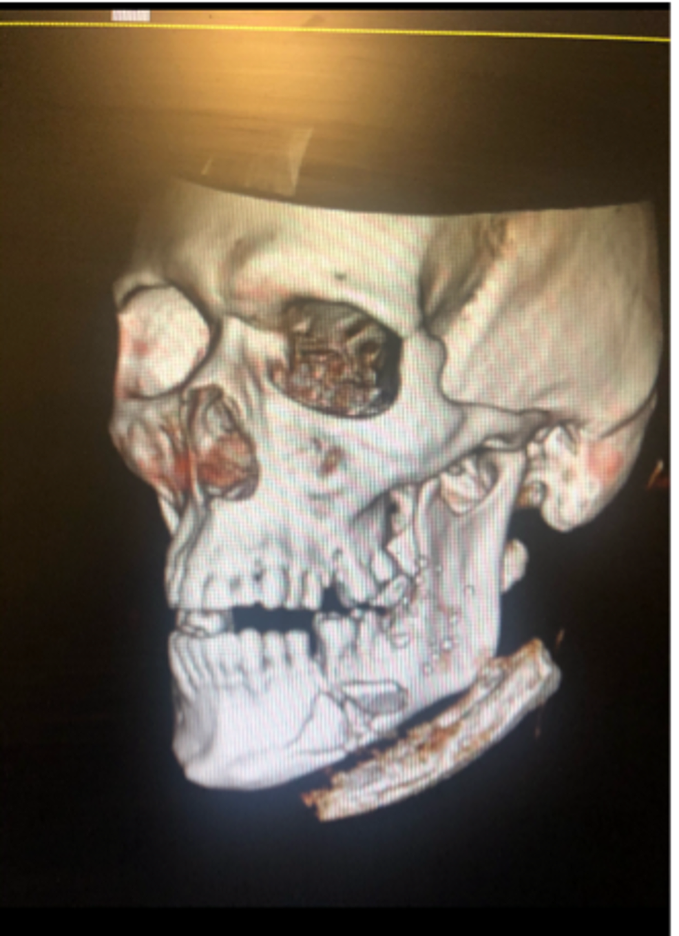 Maxillofacial-CT-scan-demonstrating-left-mandible-fracture.