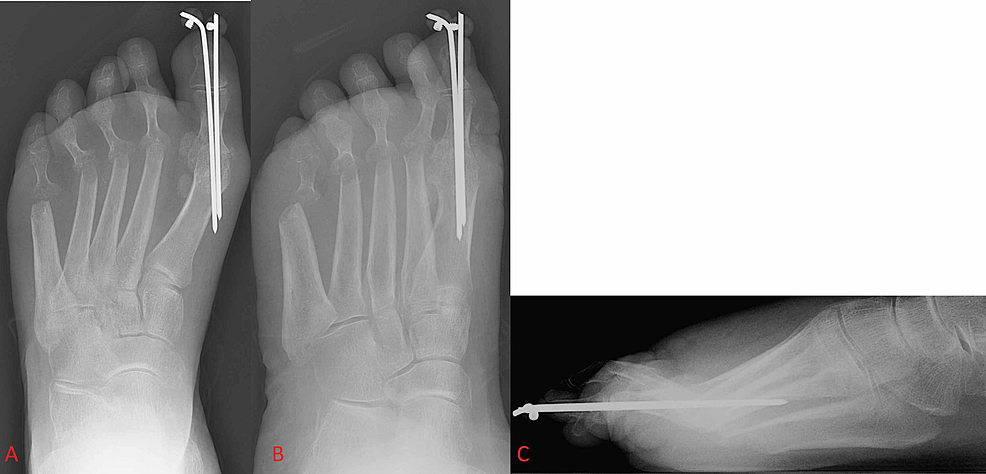 Cureus First Metatarsophalangeal Joint Arthrodesis A Narrative Review Of Fixation Constructs 