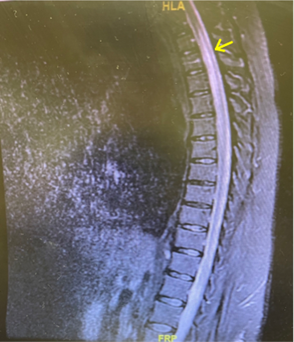 Cureus Tabes Dorsalis in a Patient Presenting With Right Lower