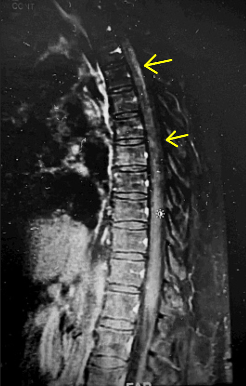 Cureus Tabes Dorsalis in a Patient Presenting With Right Lower Extremity Paresthesia and