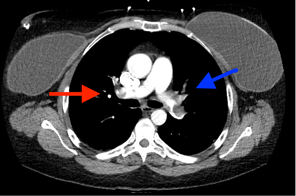 Bilateral Pulmonary Emboli On Dabigatran Cureus