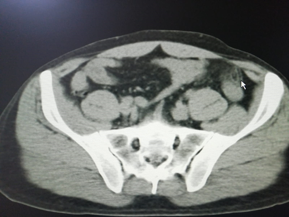 Cureus Primary Epiploic Appendagitis A Case Report