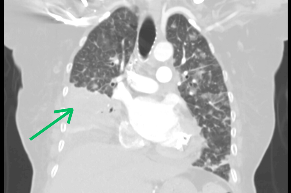 Disseminated Pulmonary Coccidioidomycosis Presenting as a Wedge-Shaped Necrotic Mass Mimicking Malignancy