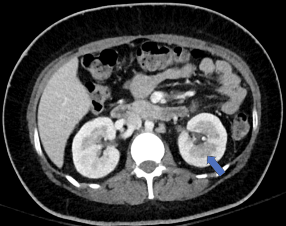 Managing Antibiotic Allergy in Renal Infection and Diabetic Ketoacidosis