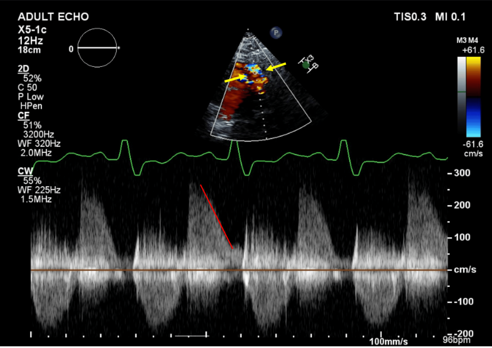 Pulmonic Valve Insufficiency After Tetralogy of Fallot Repair: Case Study & Insights