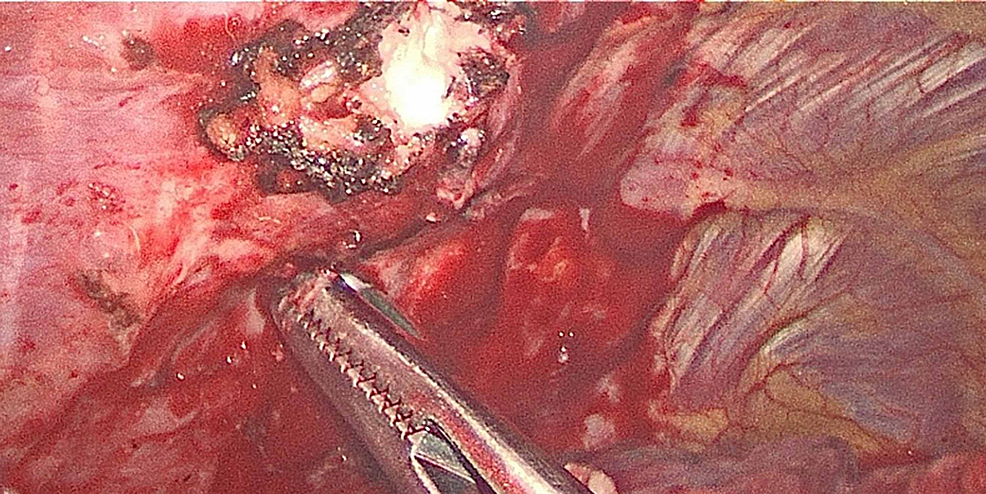 Intraoperative-image-of-rib-fracture
