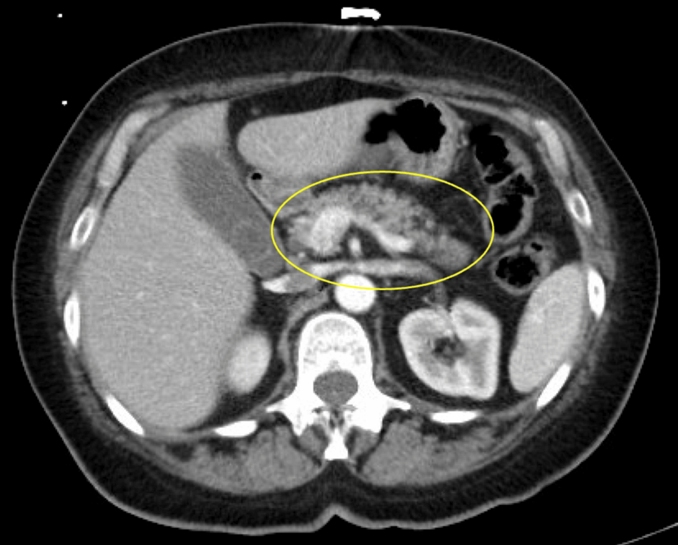 gray tirzepatide reddit A Case of an Invisible Pancreatic Neuroendocrine Tumor Decoded by  Endoscopic Ultrasound