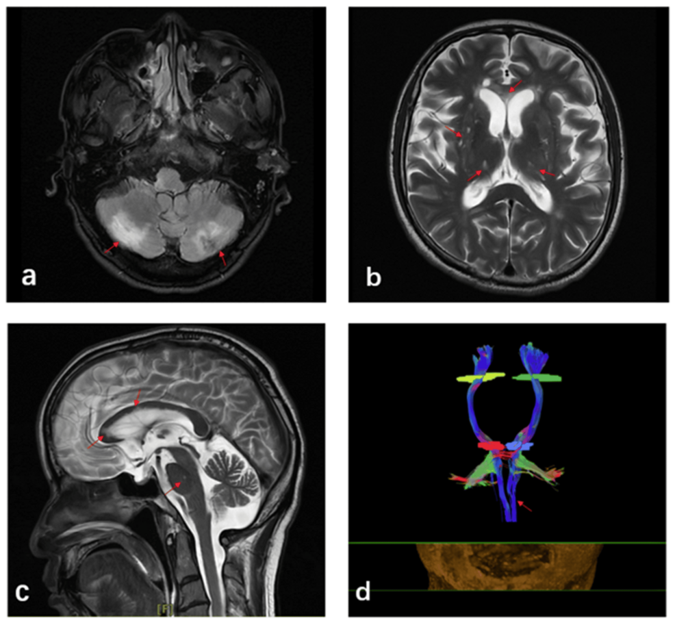 Cerebellar Repetitive Transcranial Magnetic Stimulation (rTMS) With Modified Proprioceptive Neuromuscular Facilitation (PNF) Balloon Dilation for Dysphagia After Brainstem and Cerebellar Infarction: A Case Report