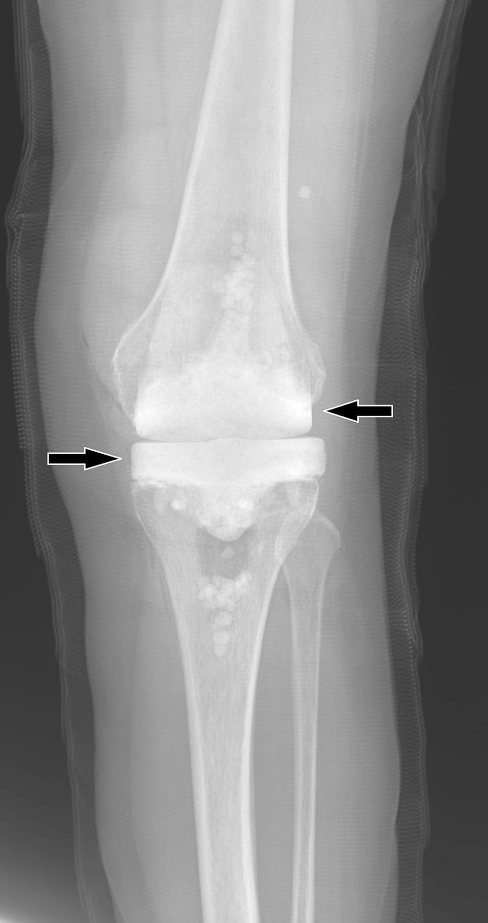 Cureus Two Stage Total Knee Arthroplasty Revision With Extended Antibiotic Spacer Use