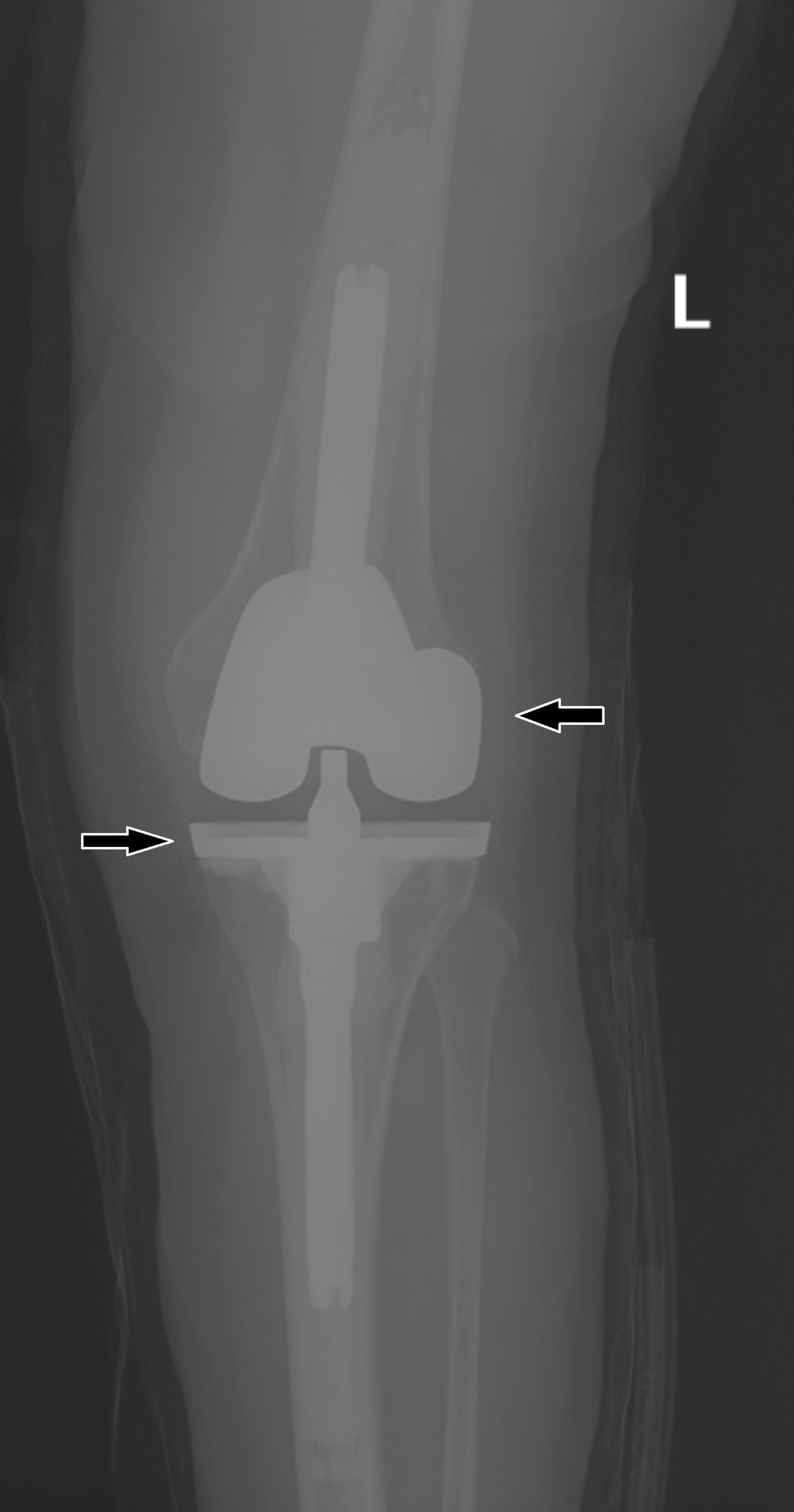 Cureus Two Stage Total Knee Arthroplasty Revision With Extended