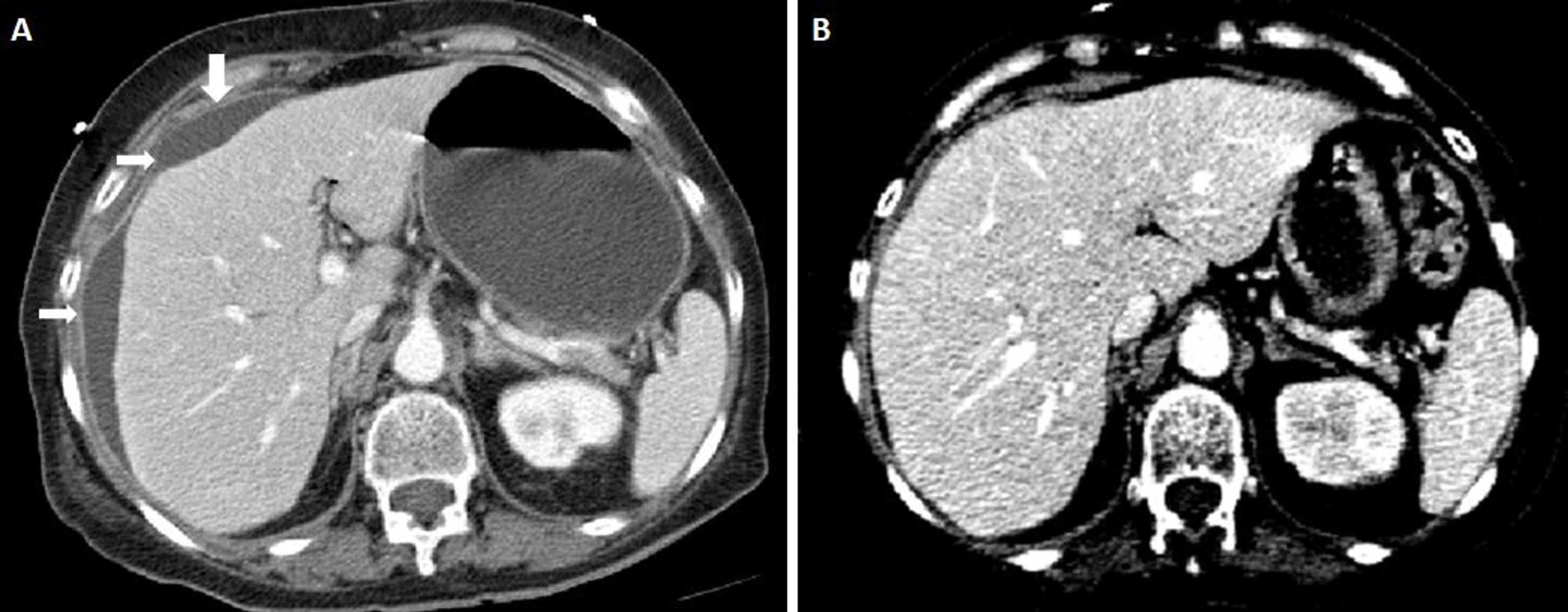 Cureus | Hepatic Candidiasis in an Immunocompetent Patient: A ...