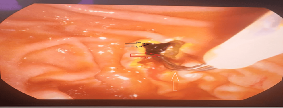 LC-First vs. ERCP-First Approach for Cholecystocholedocholithiasis