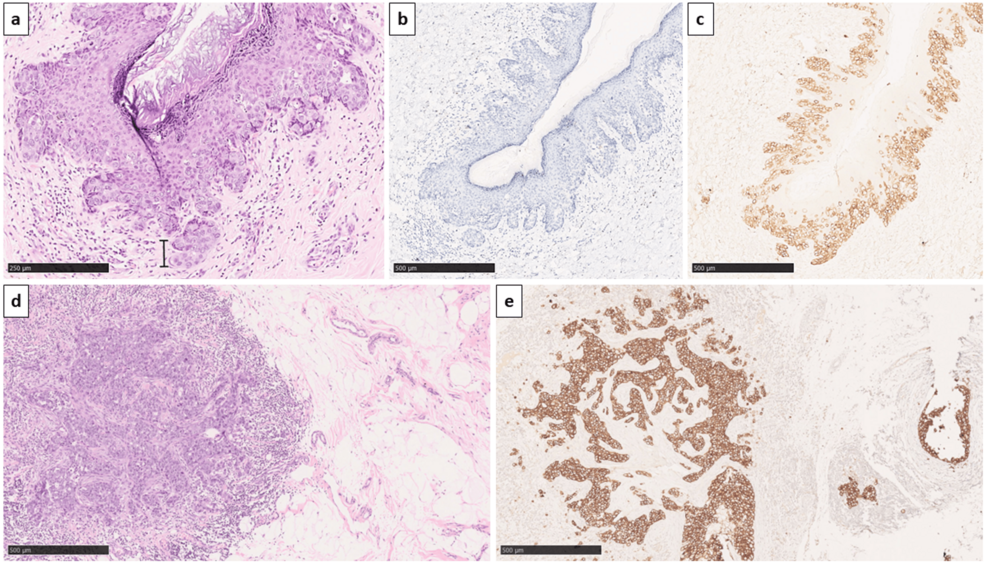 Invasive Paget's Disease of the Breast: A Staging Pitfall Mimicking pT4 Disease