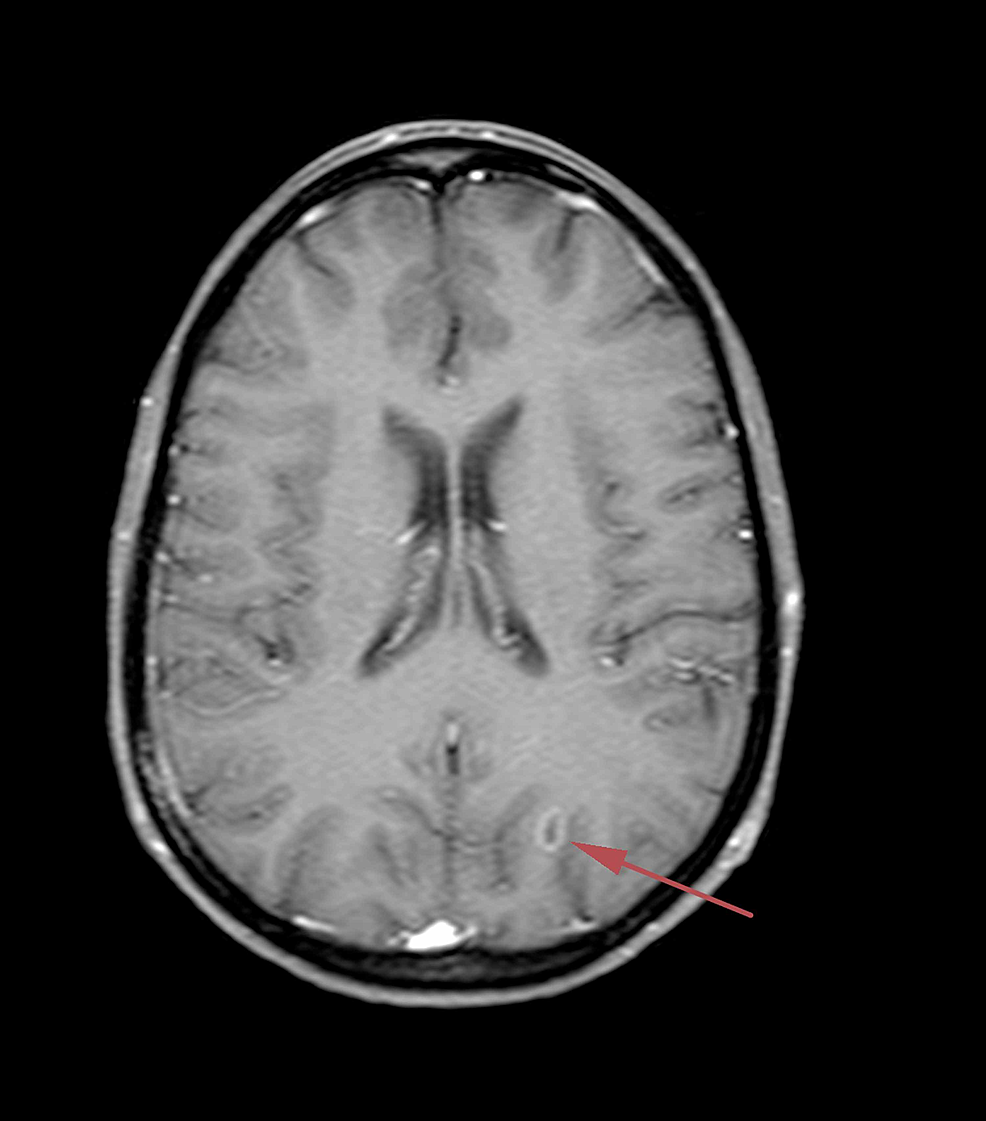 T1-weighted-axial-brain-magnetic-resonance-image-with-contrast-dated-November-5,-2018