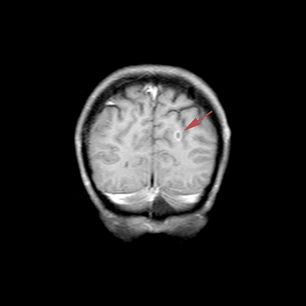T1-weighted-coronal-brain-magnetic-resonance-image-with-contrast-dated-November-5,-2018