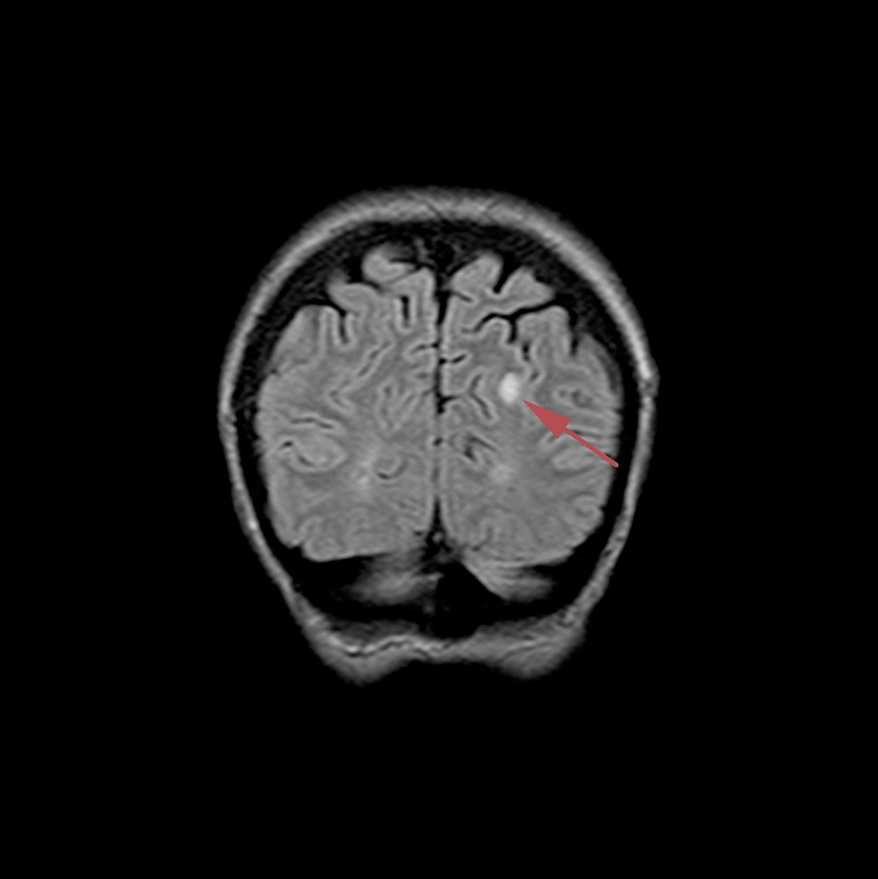 Coronal-FLAIR-brain-magnetic-resonance-image-dated-November-5,-2018-where-a-roughly-8-mm-sized-lesion-with-peripheral-contrast-enhancement-in-correlation-with-a-metastatic-lesion-is-seen-at-the-left-occipital-horn-posterior-area