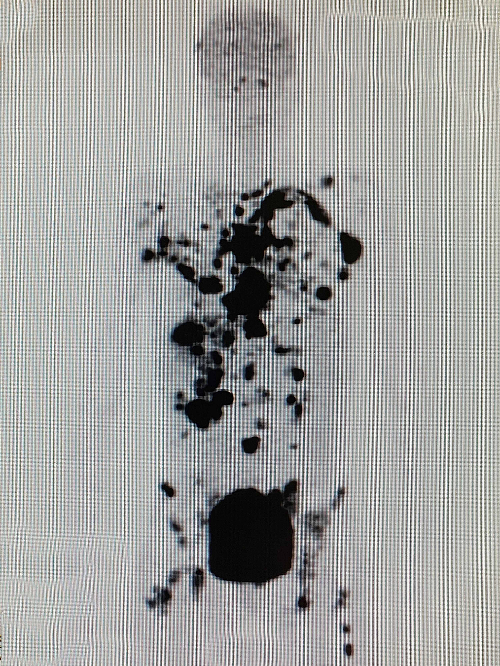 Whole-body-(18F)-FDG-PET/CT-scan-done-before-treatment-on-November-5,-2018-showing-widespread-multiple-metastatic-lesions-at-the-lungs,-mediastinum,-liver,-abdomen-and-bones.