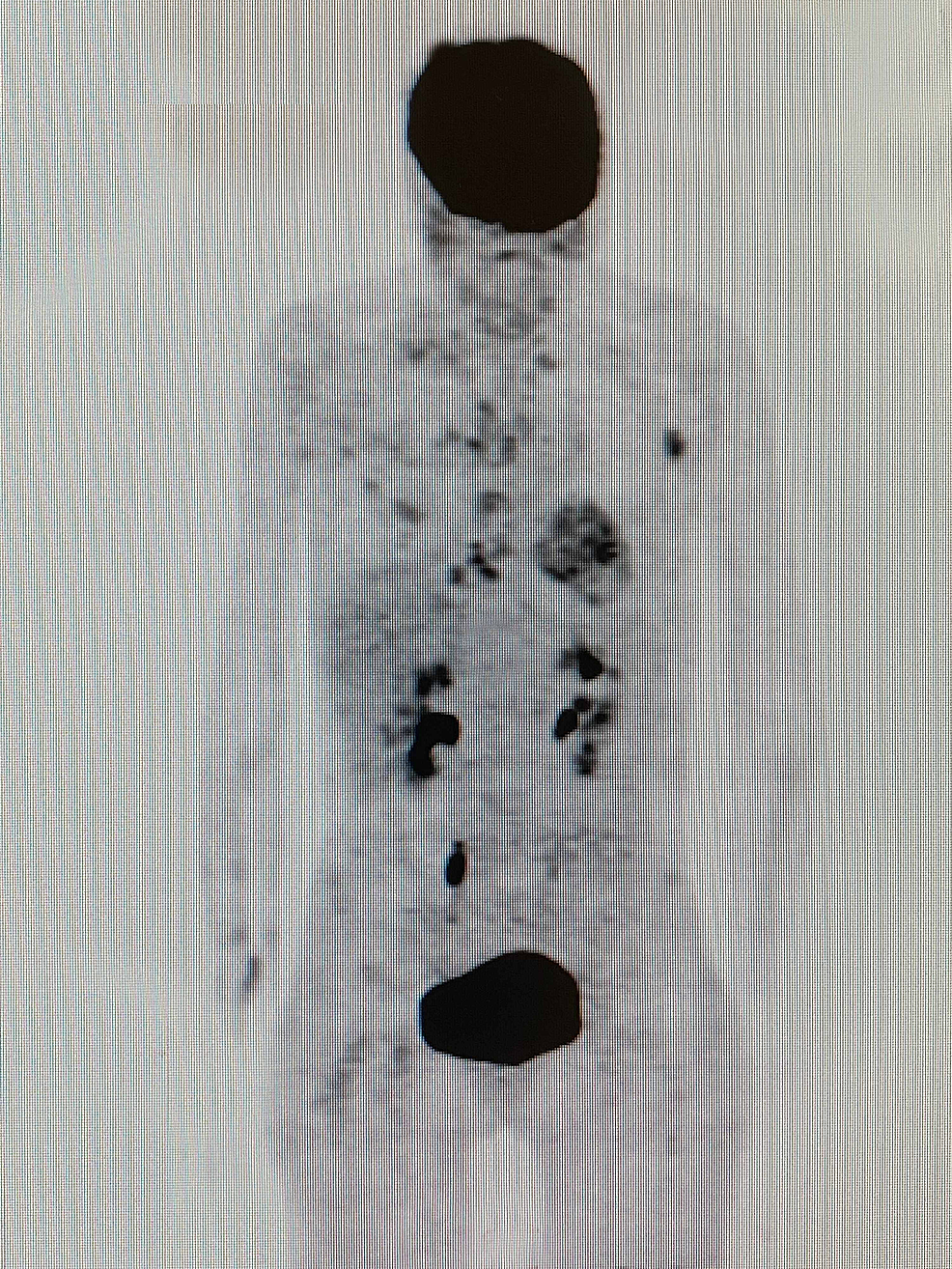 Whole-body- (18F) -FDG-PET-CT-scan-done-done-after-four-cycles-of-MSCT, -KD, -HT, -and-HBOT-treatment- (16 ianuarie -2019) - prezentarea-unui-răspuns-parțial-la-tratamentul-leziunilor-hepatice-metastatice-și-LAP-axilare-stânga-și-răspuns-complet-la-tratament-la-toate-celelalte-leziuni