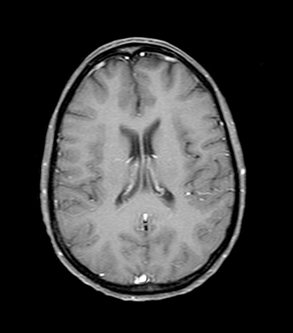 Imagine-cu-rezonanță-magnetică-creier-axială-ponderată-T1 cu contrast-pe-25 aprilie-2019