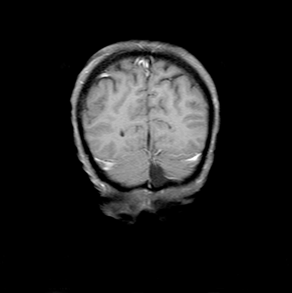 T1-weighted-coronal-brain-magnetic-resonance-image-with-contrast-on-April-25,-2019