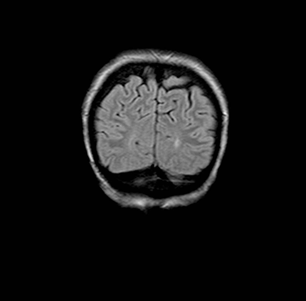 Coronal-FLAIR-imagine-rezonanță-magnetică-cerebrală-pe-25 aprilie-2019-cu-aceleași-secvențe-ca-ale-creierului-RMN-efectuate-pe-5 noiembrie, - 2018-dezvăluie-o-leziune-de-dimensiune-aproximativ-8-mm-cu-îmbunătățire-contrast-periferică-în-corelație-cu-o-leziune-metastatică-care-nu-a-mai-fost-la-stânga- occipital-corn-zona-posterioară