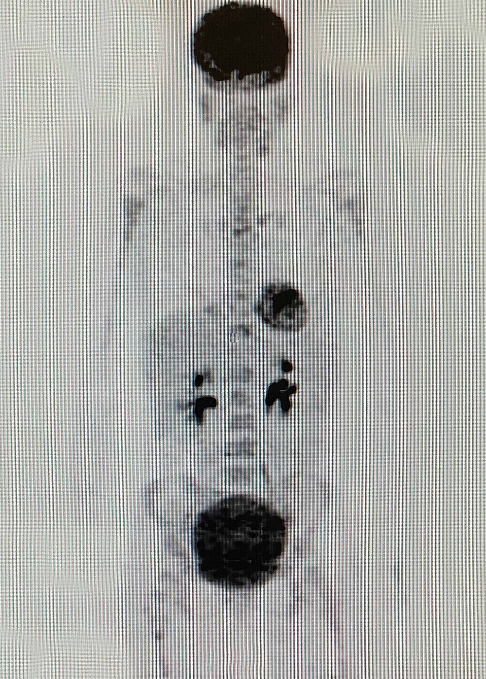 Whole-body-(18F)-FDG-PET-CT-scan-done-on-April-25,-2019-after-nine-cycles-of-MSCT,-KD,-HT,-and-HBOT-treatment-showing-no-pathological-FDG-uptake,-indicative-of-a-complete-response