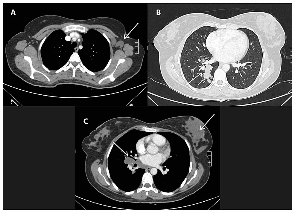 Cureus Complete And Durable Response To Tamoxifen And Ovarian 