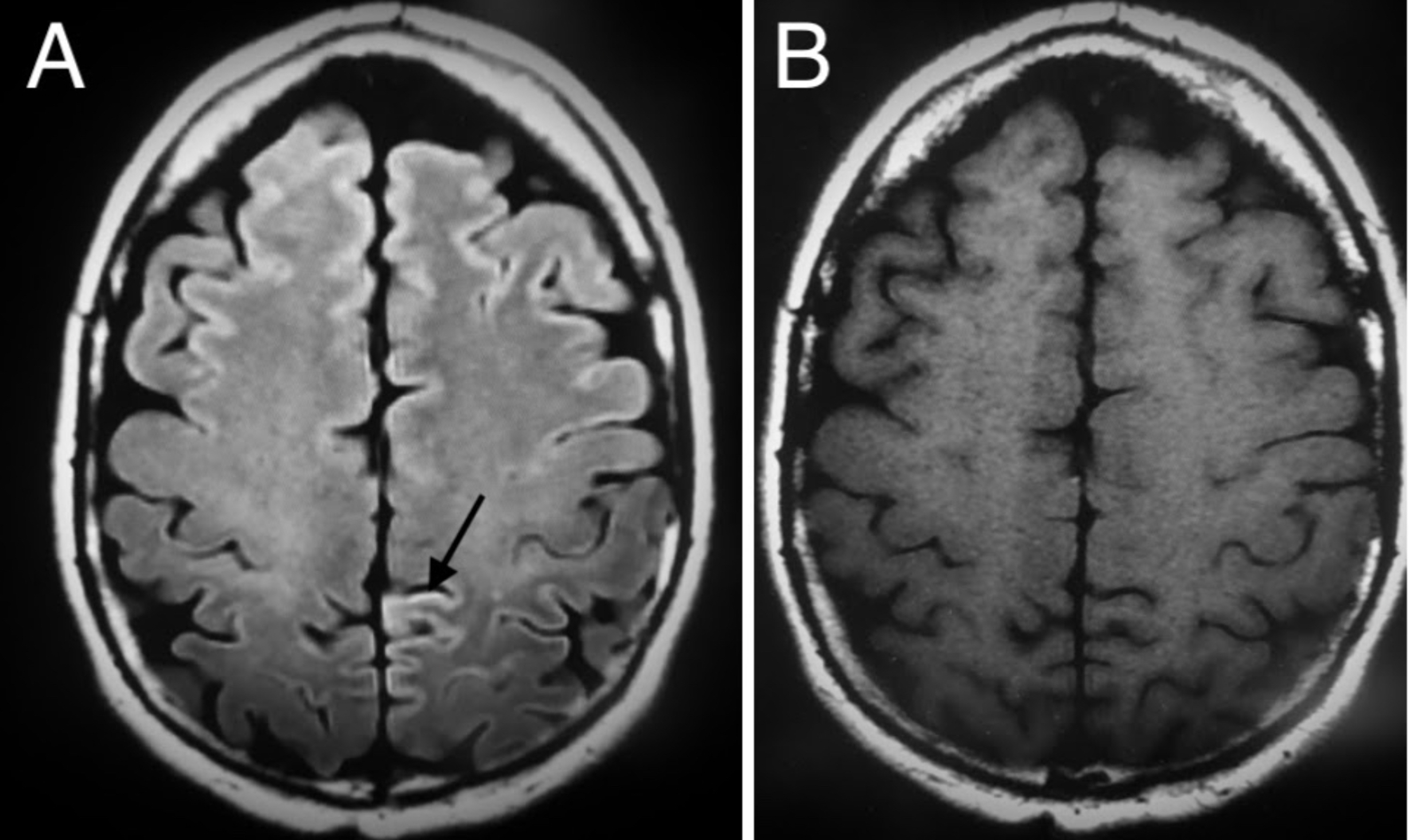 Cureus Rapid Neurocognitive Deterioration and Mortality in a