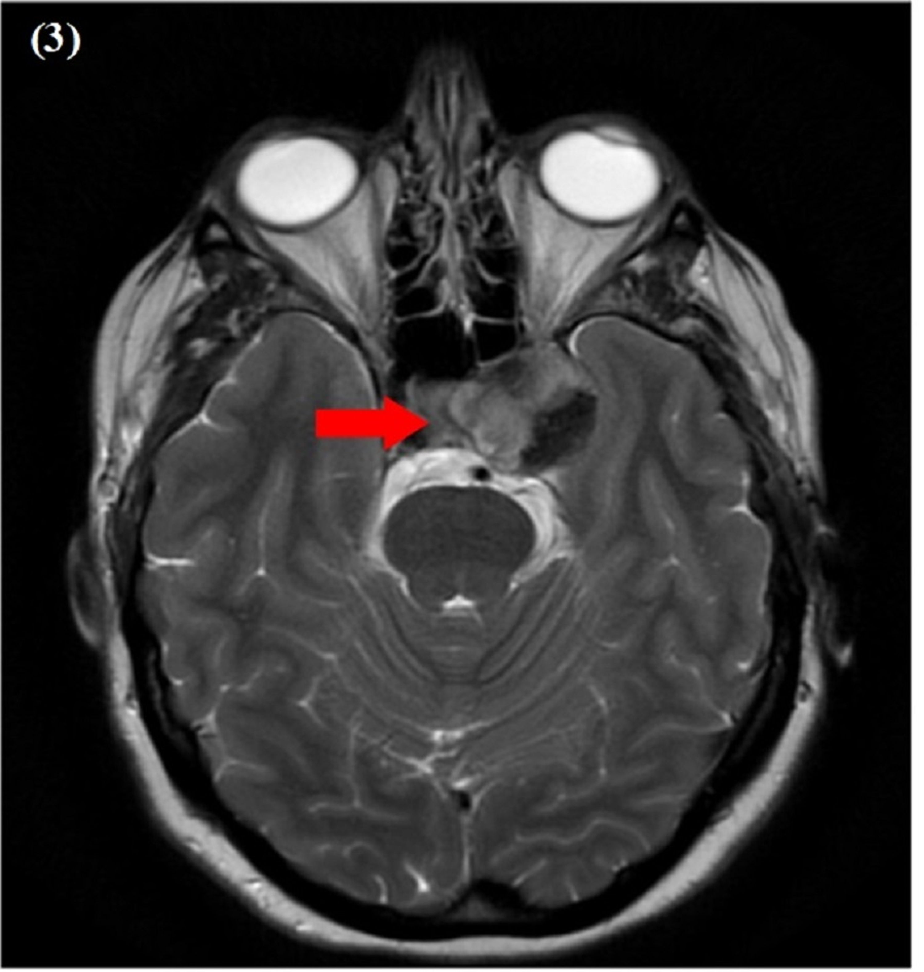 3rd Cranial Nerve Mri 2526