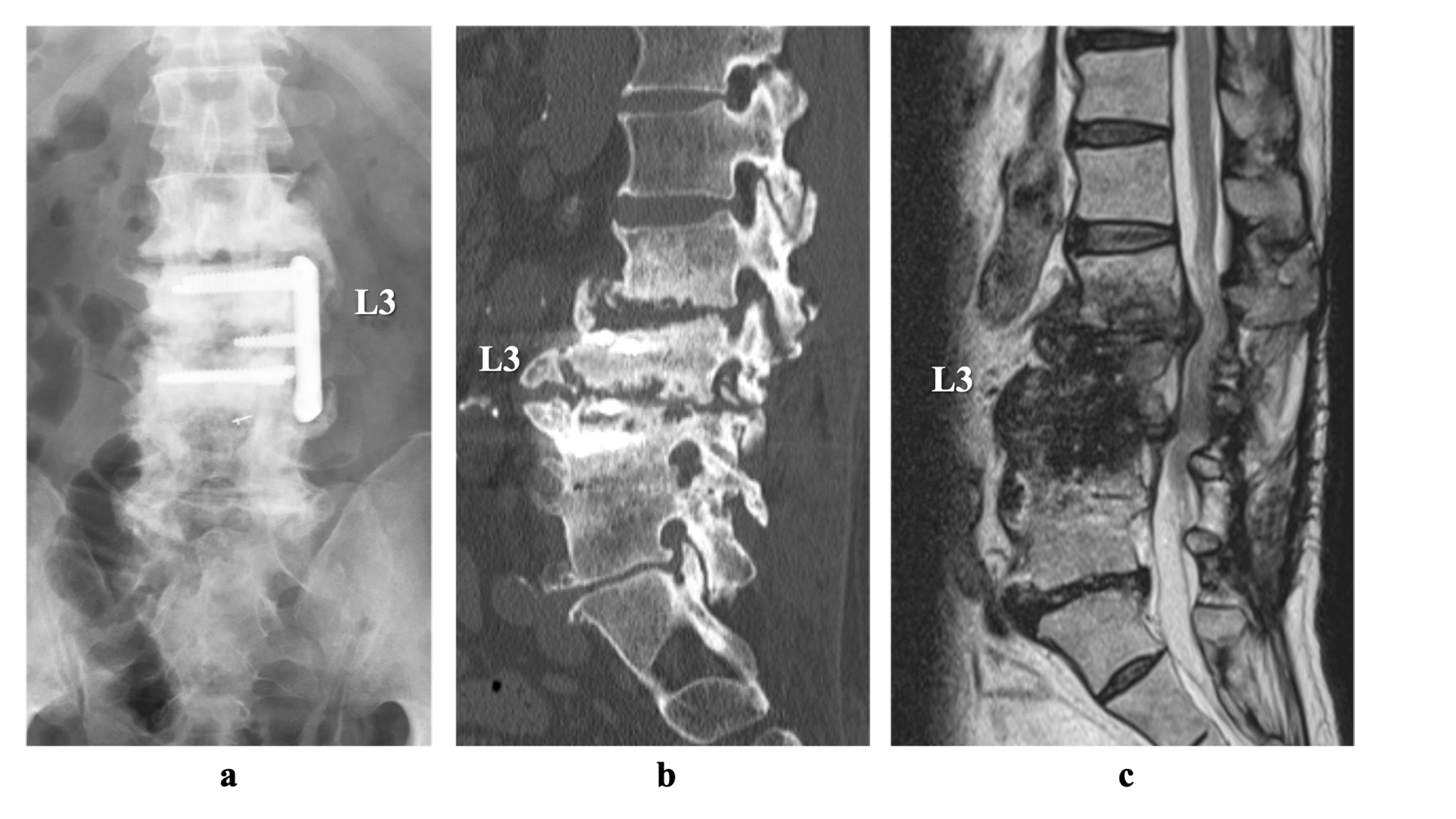 Candida Spondylitis Considered As Microbial Substitution After Multiple ...