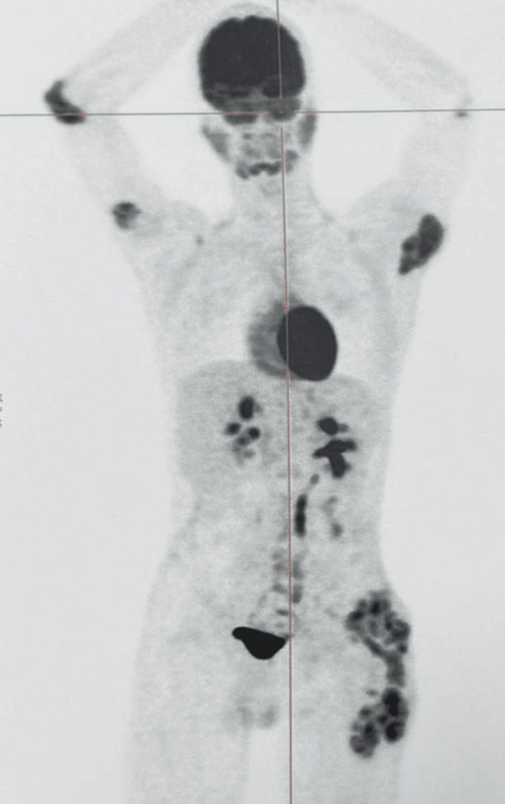 Whole-body-PET-CT-maximum-intensity-projection-image-demonstrating-multiple-areas-of-increased-radiotracer-uptake-correspondi