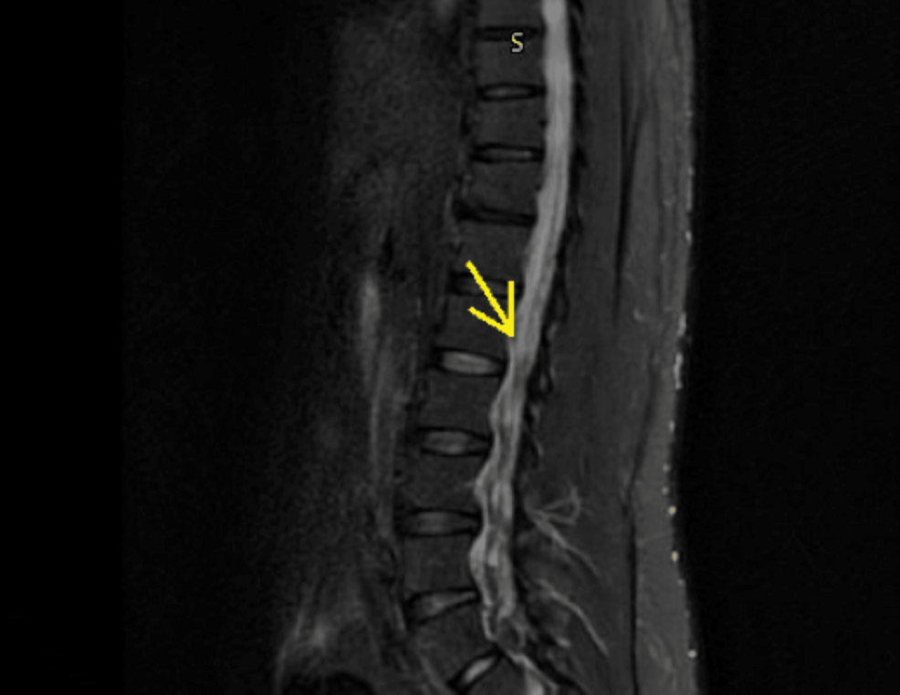 headline: Guillain-Barré Syndrome Following Seasonal <b>Coro