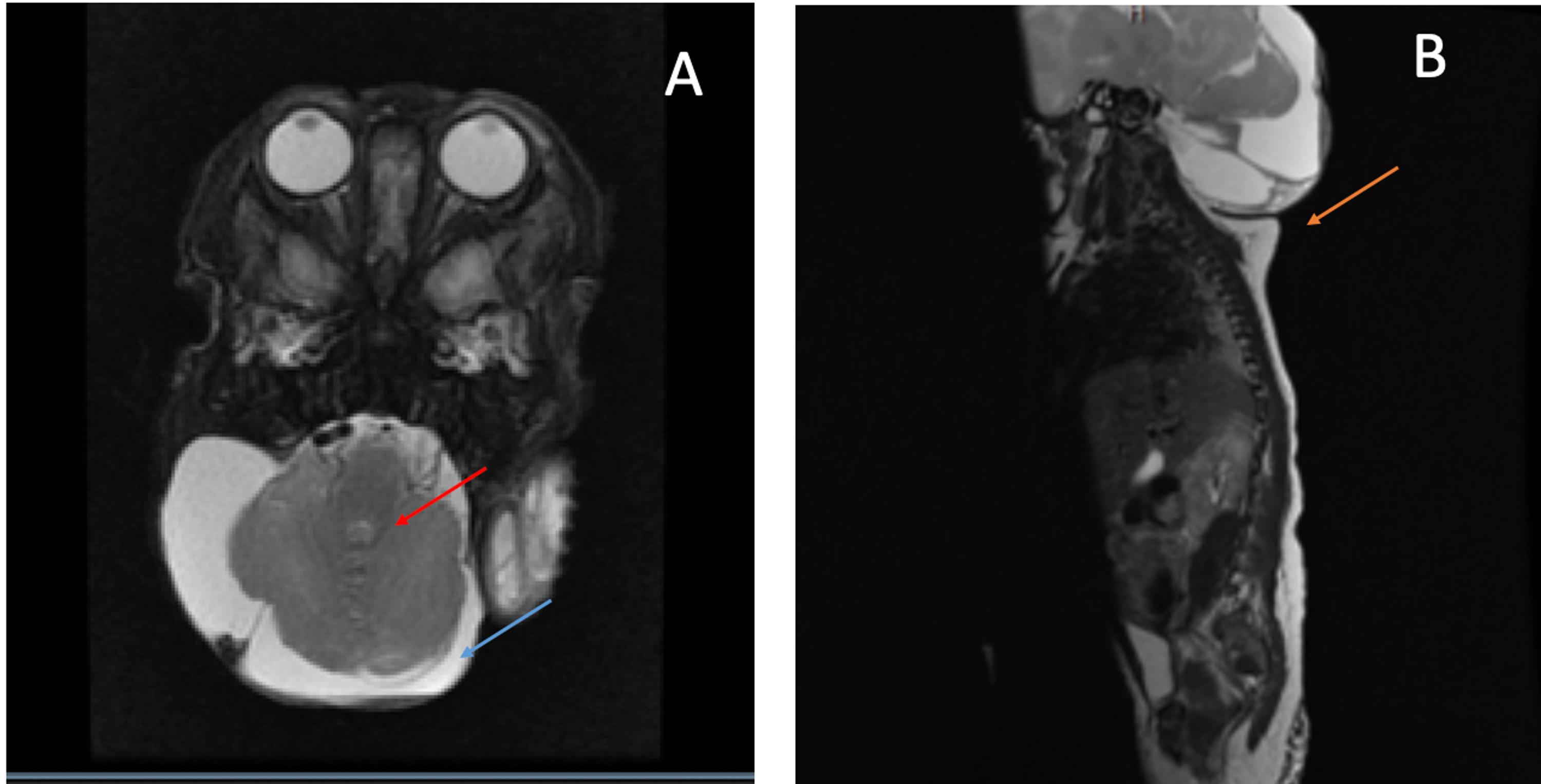 chiari malformation type 3