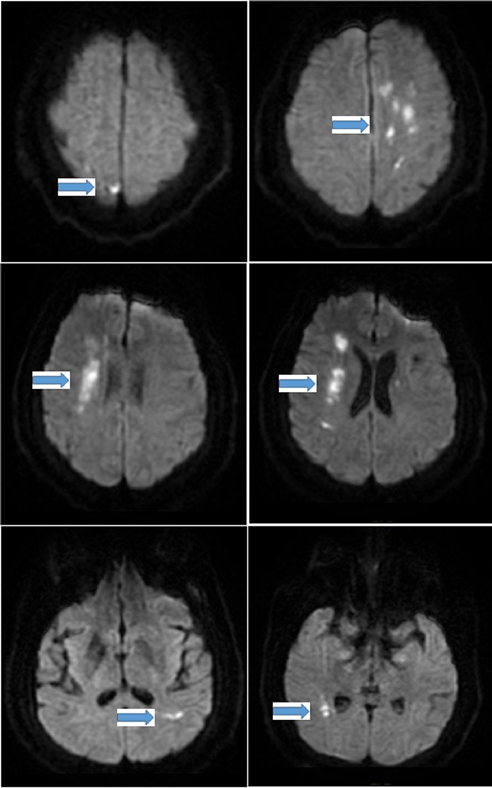 Cureus Acute Multiple Cerebral Watershed Infarctions As The Initial