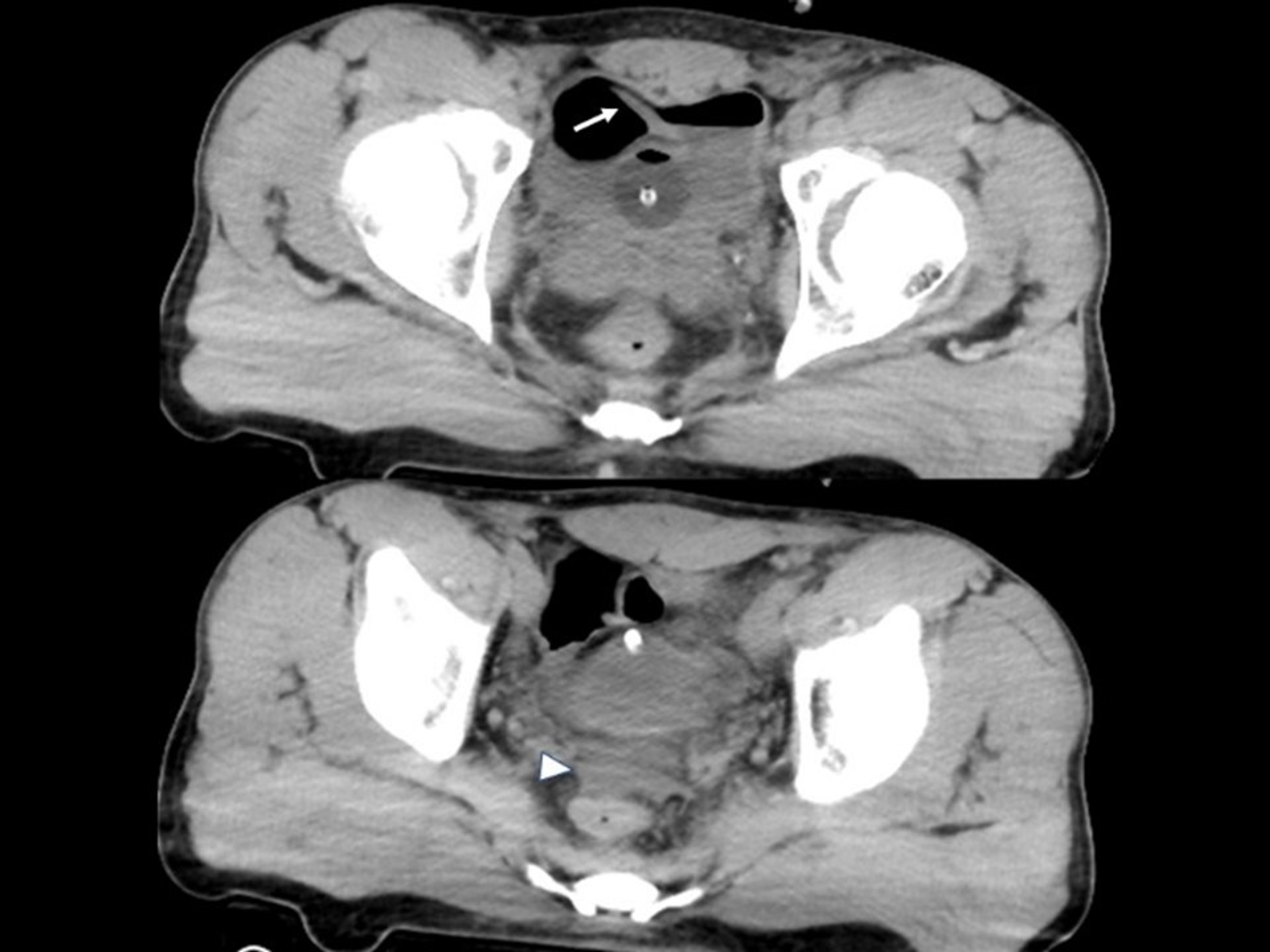 Cureus Transient Trabecular Formation in the Bladder and Delayed Free Air due to Traumatic