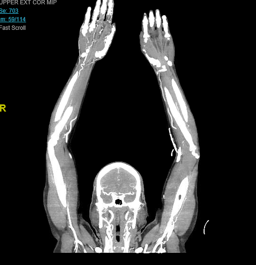 Upper Extremity Arteries Ct