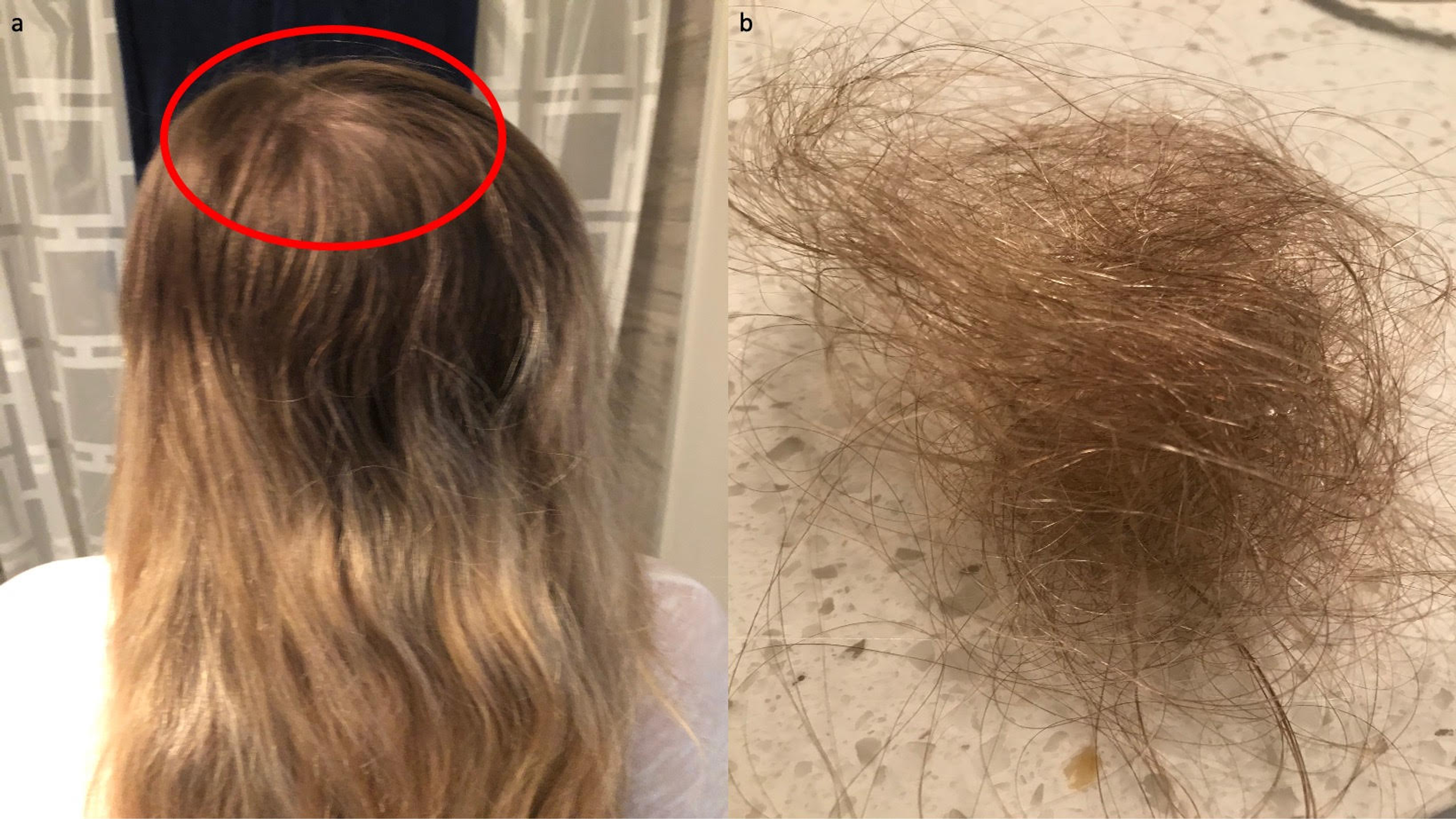 Cureus | Bariatric Surgery-Induced Telogen Effluvium (Bar SITE): Case  Report and a Review of Hair Loss Following Weight Loss Surgery | Article
