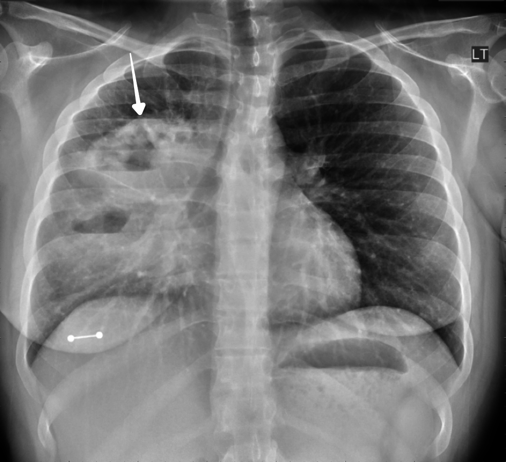 Cureus Primary Pulmonary Hodgkin's Lymphoma A Rare