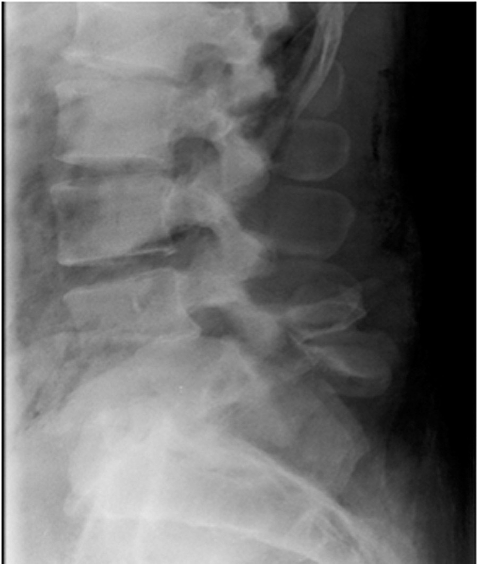 Traumatic L5 Posterolateral Spondyloptosis: A Case Report and Review of ...