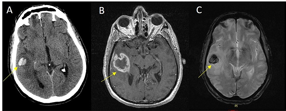 Axial-noncontrast-CT-(A)-demonstrates-intraparenchymal-presumed-hematoma-in-this-post-traumatic-patient.-Axial-postcontrast-T1-MRI-image-(B)-shows-a-thick-rim-enhancing-focus-at-the-site-of-hemorrhage,-which-is-confirmed-by-blooming-on-GRE-series-(C).-There-is-surrounding-edema.