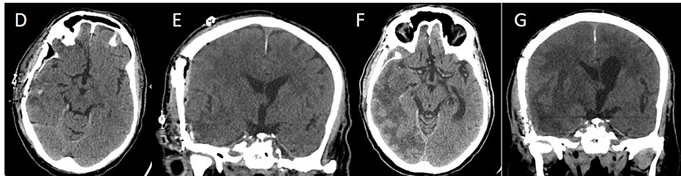 Axial-(D)-and-coronal-(E)-noncontrast-CT-images-demonstrate-post-surgical-changes-after-right-sided-craniotomy-with-evaluation-of-the-hematoma.-However,-follow-up-CT-(axial-(F)-&-coronal-(G))-nine-months-later,-demonstrate-marked-right-cerebral-hemisphere-edema-centered-at-right-temporal-lobe-with-mass-effect-on-the-right-lateral-ventricle-with-right-to-left-midline-shift.